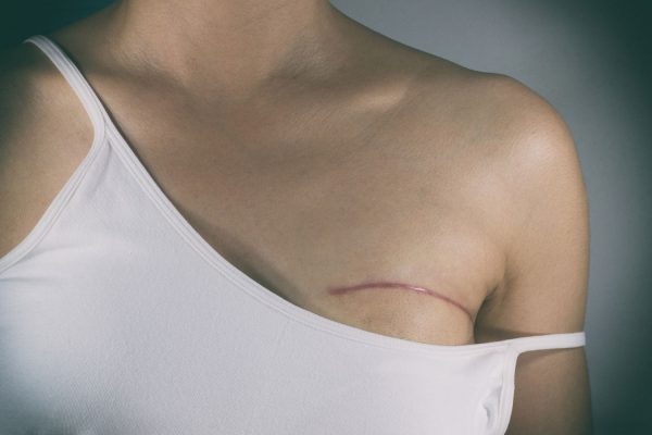 Getting A Double Mastectomy Doesn’t Increase Breast Cancer Survival Rate, New Study Finds