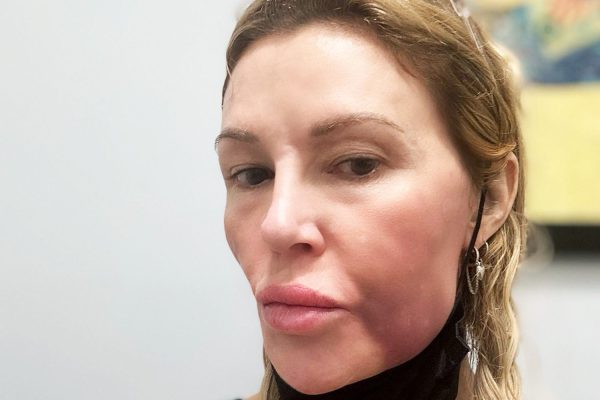 Brandi Glanville Shares Photo of Facial Disfigurement from Stress-Induced Angioedema: ‘I’m Miserable and Depressed’